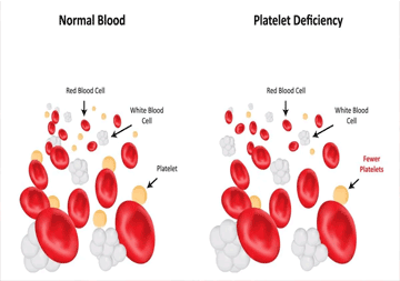 platelets-disorder