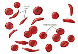 sickle-cell-anemia